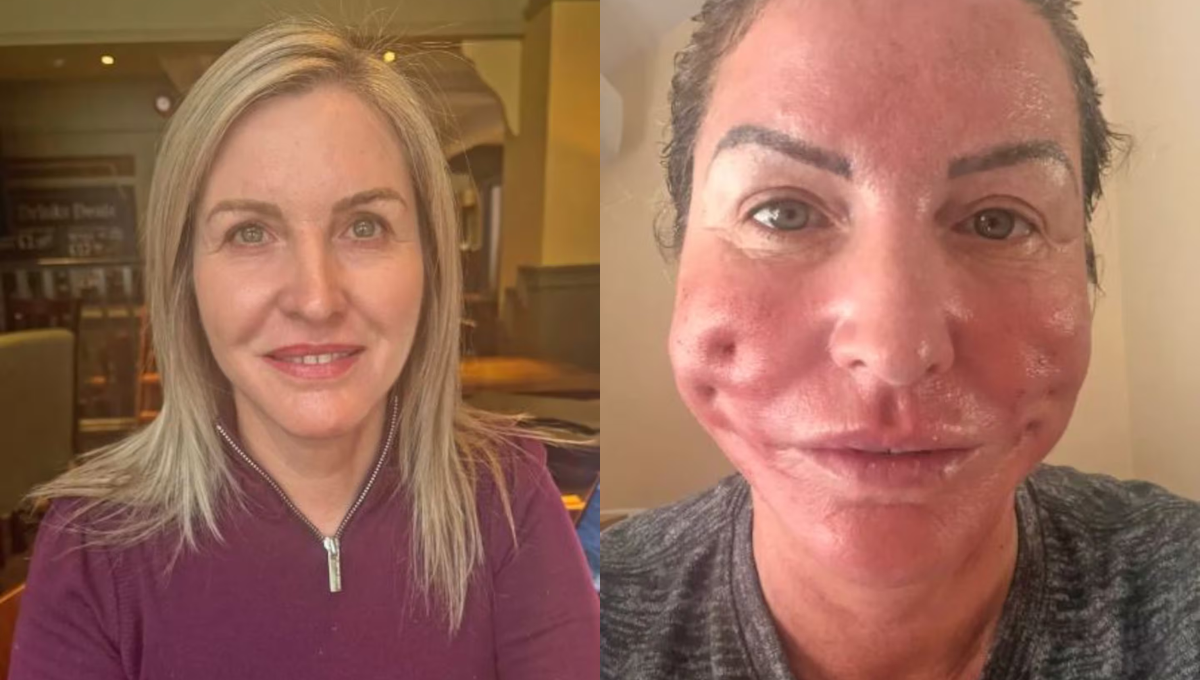 Pagó 1.600 dólares por un lifting y terminó con agujeros en la cara