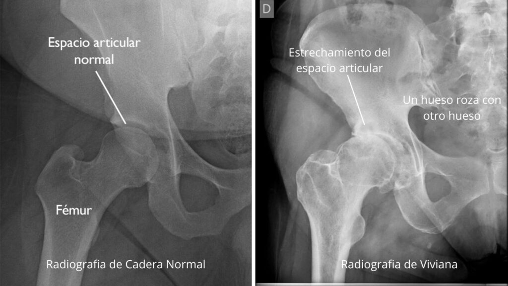 (Izquierda) En esta radiografía de una cadera normal, el espacio entre la bola y la cavidad es signo de un cartílago sano. (Derecha) Esta radiografía de la cadera de Viviana, con artrosis, muestra la pérdida grave del espacio articular.